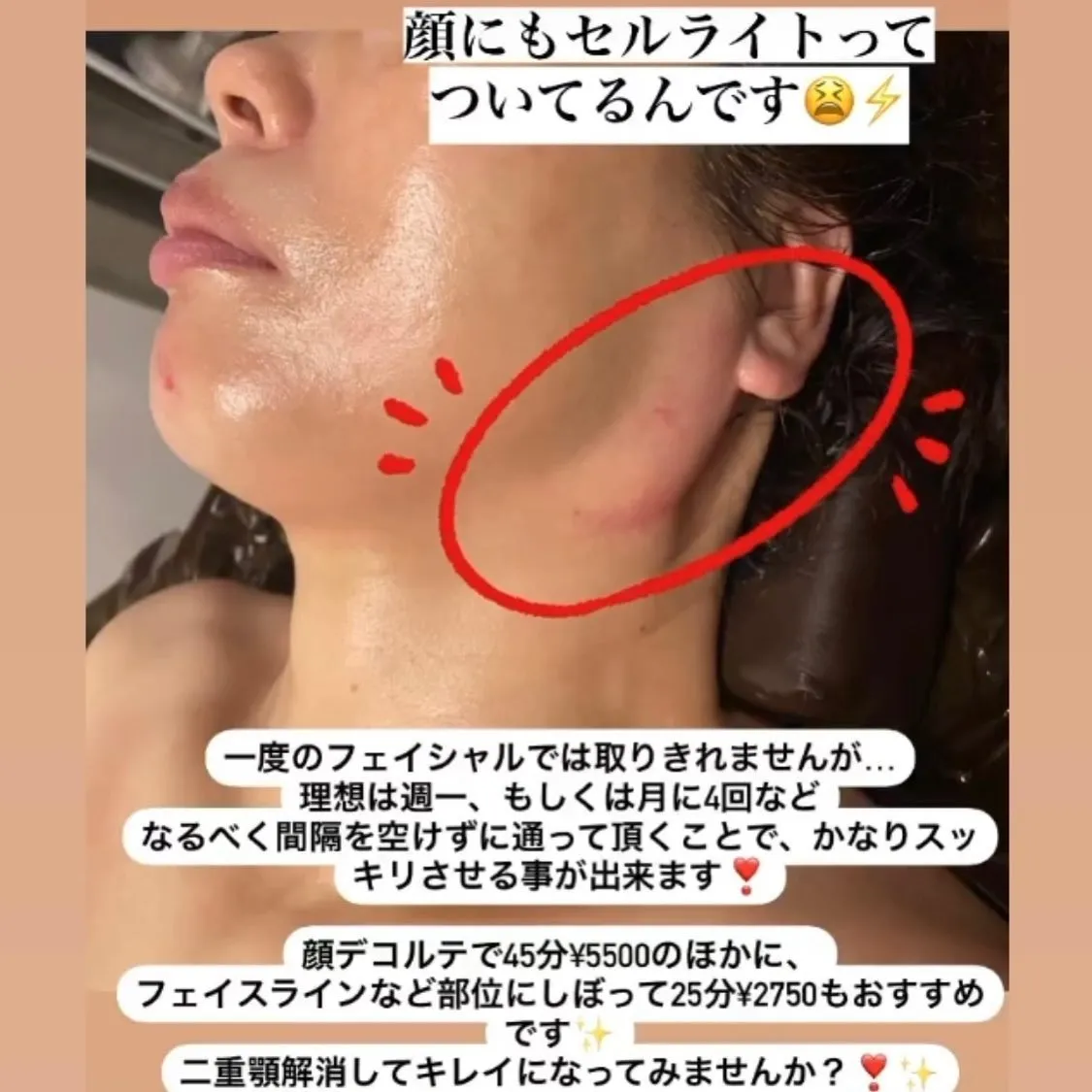 顔のセルライト⚡️