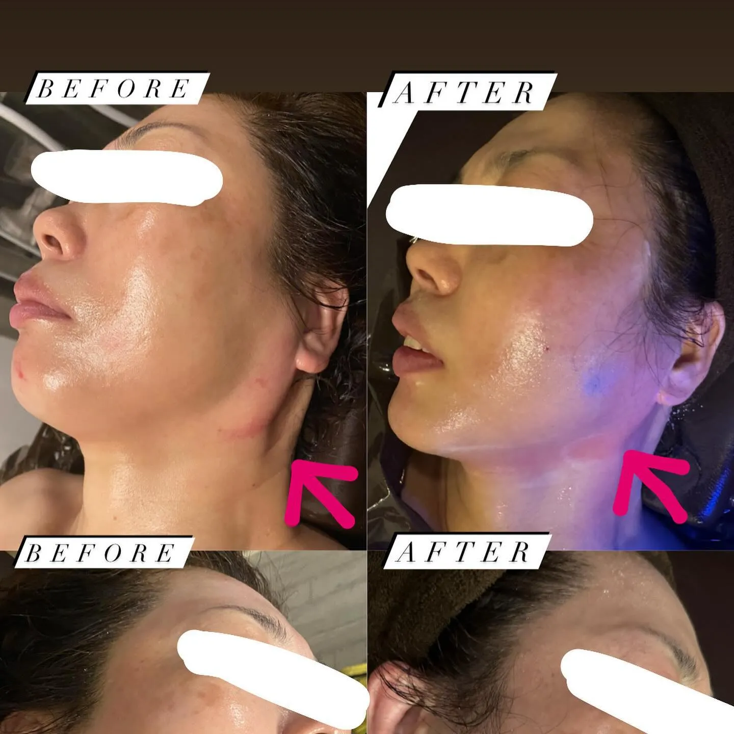 【西宮のエステ】顔のセルライトが薄く…！！【整骨院】