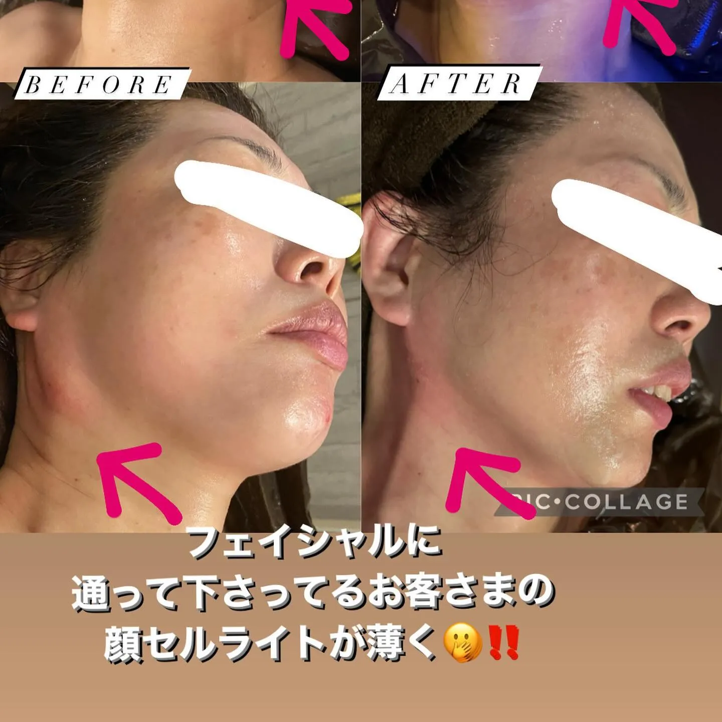 【西宮のエステ】顔のセルライトが薄く…！！【整骨院】