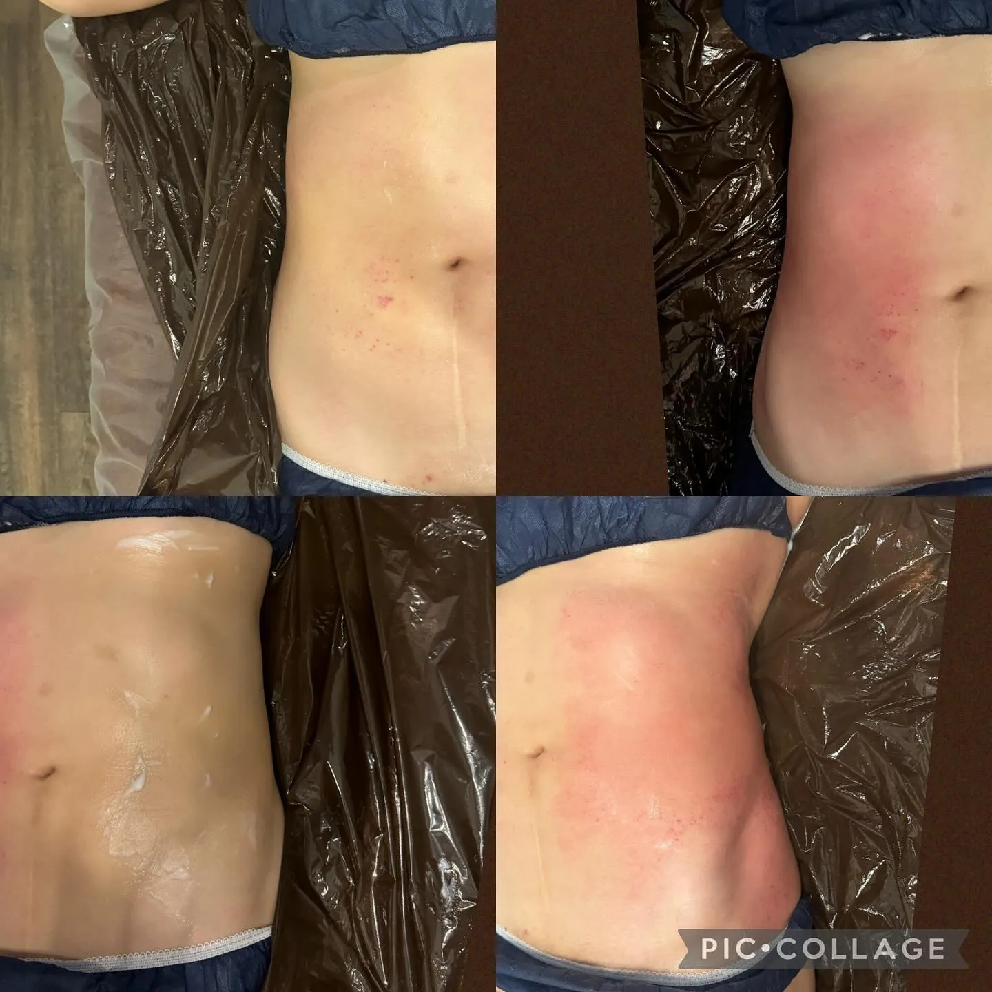 【西宮のエステ】お腹の横肉、腰肉が一度でこの変化！！【セルゼ...