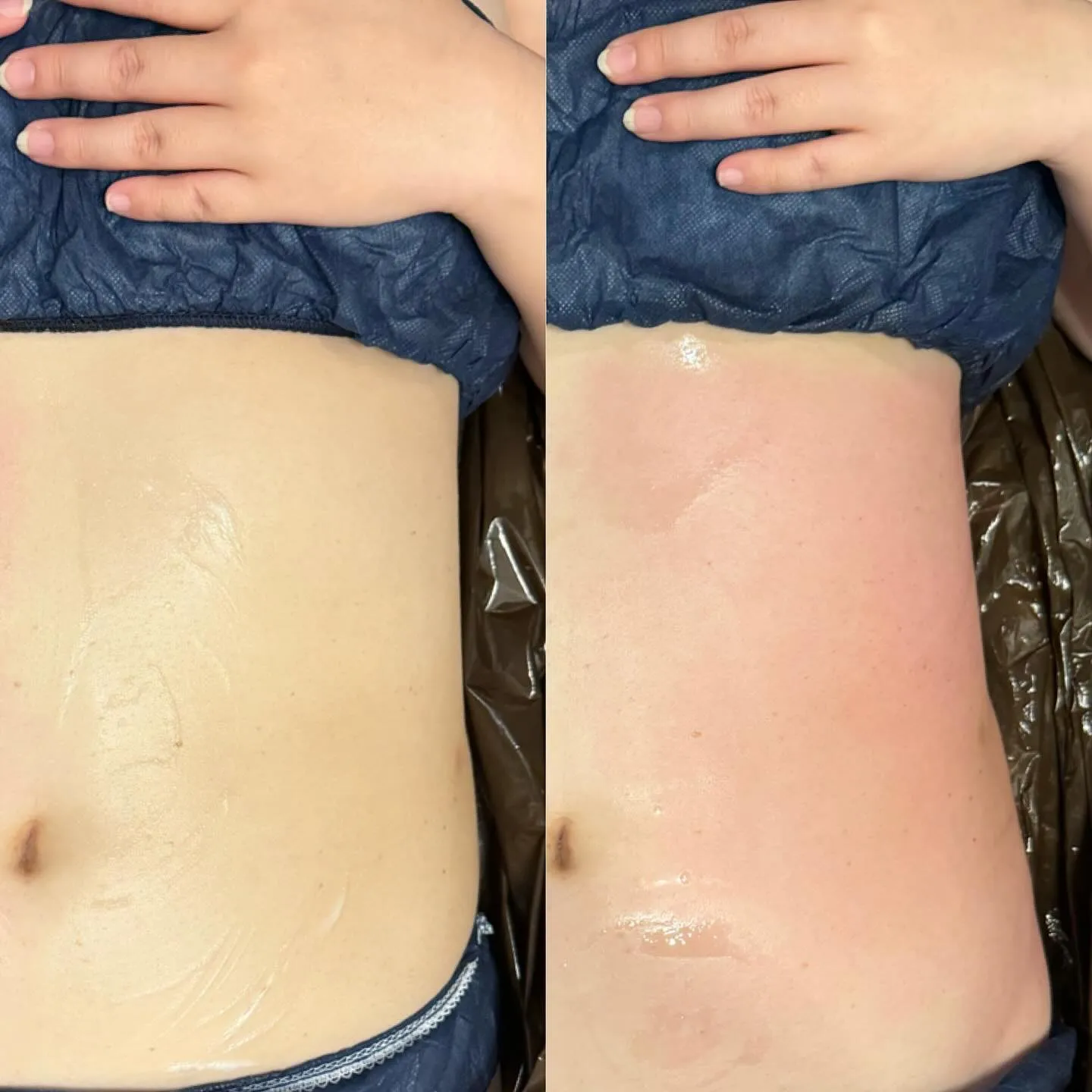 【西宮のエステ】お腹の横肉、腰肉が一度でこの変化！！【セルゼ...