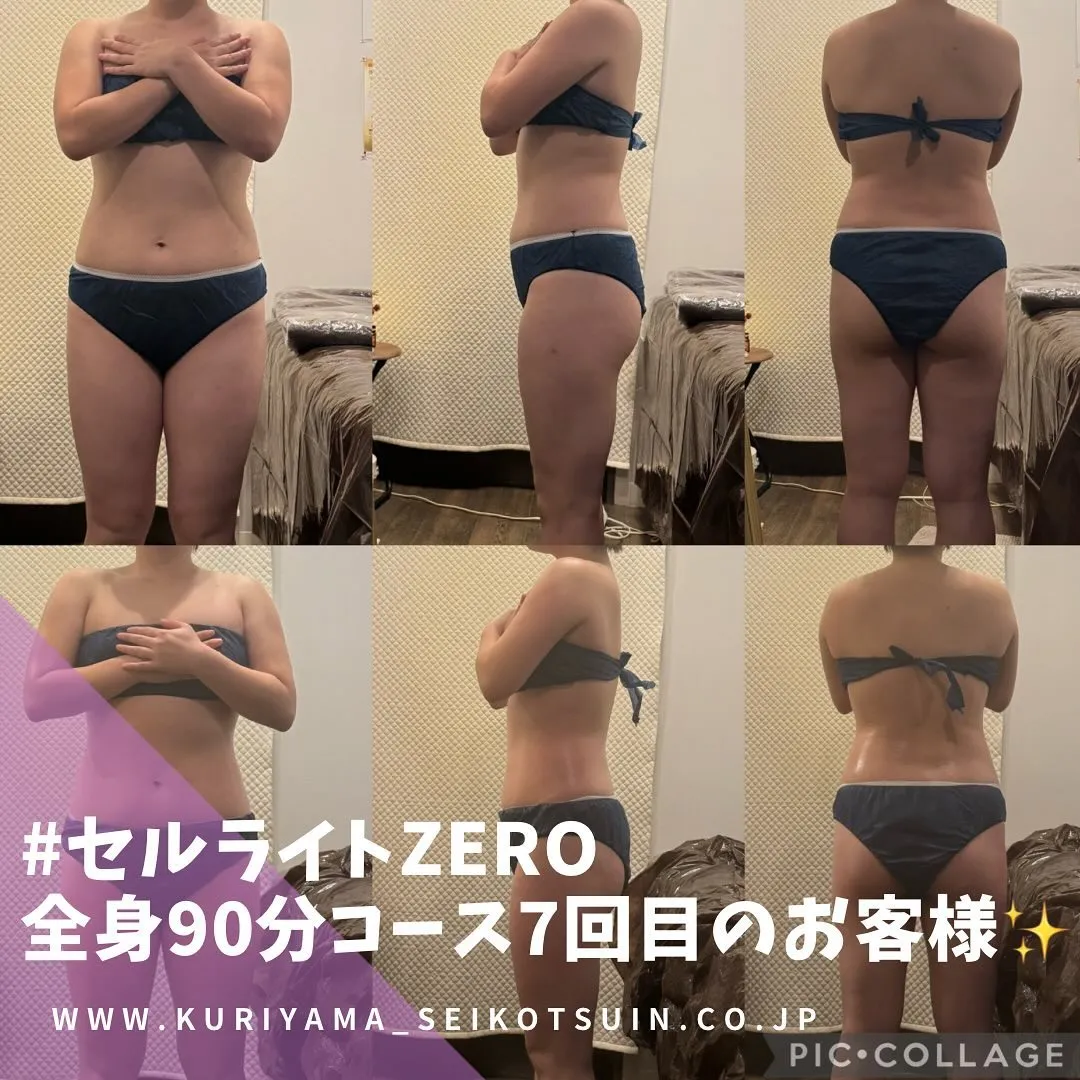 セルライト＝誰にでも年齢分蓄積している体のサビはどうして自力では取りにくいの？✨