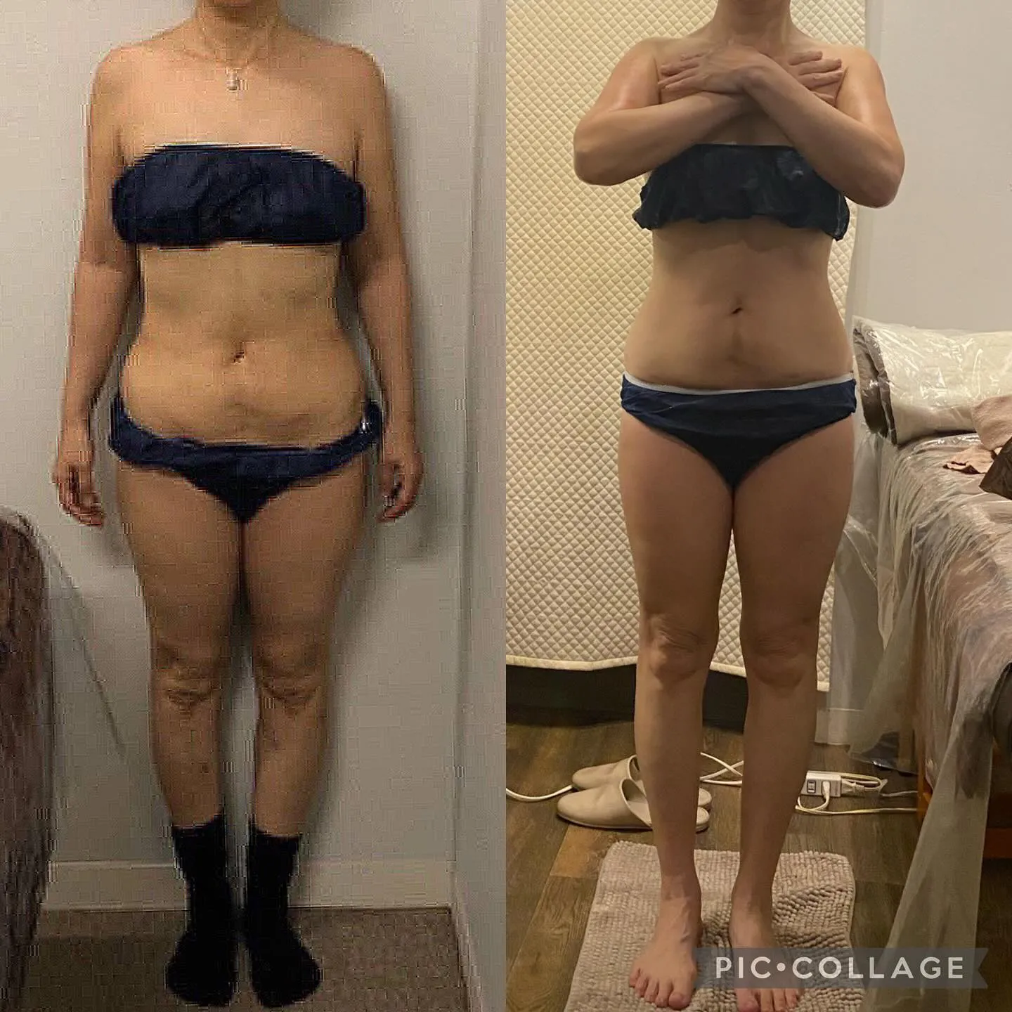 【西宮のエステ】セルゼロBefore→After✨正面【セル...