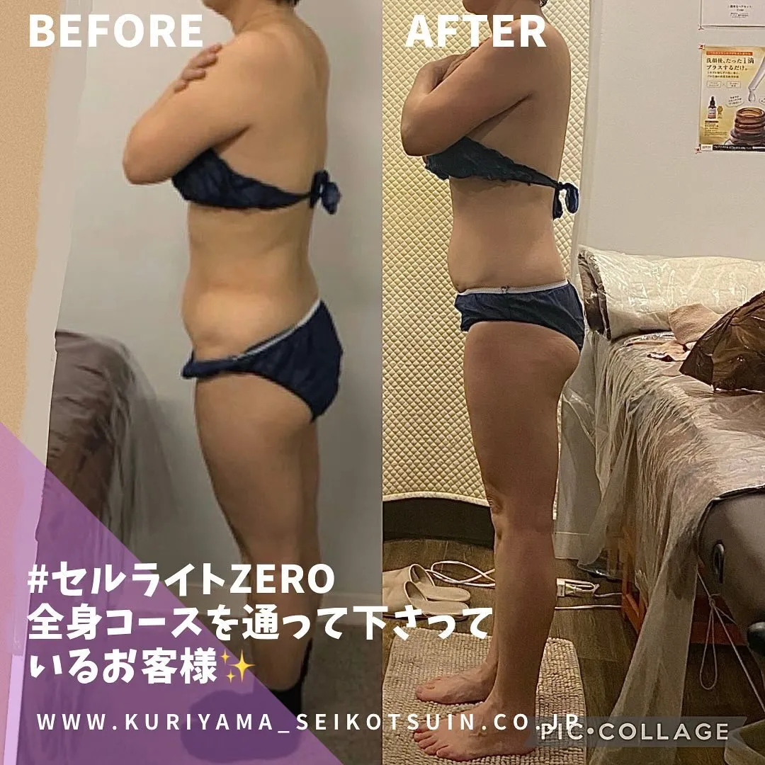 西宮市のセルライトゼロ2というマシンとはどういうもの？施術のビフォーアフターのお写真✨