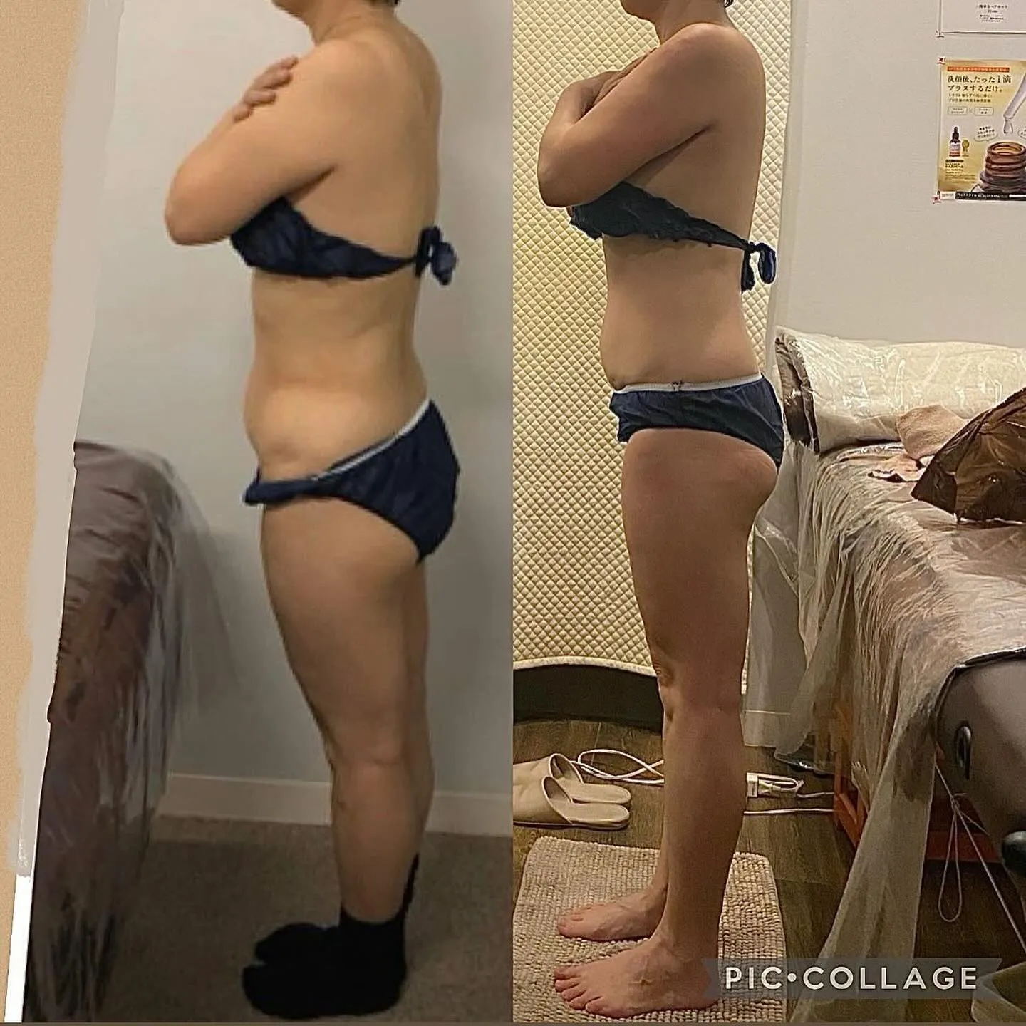 【西宮のエステ】セルゼロBefore→After✨サイド【セ...