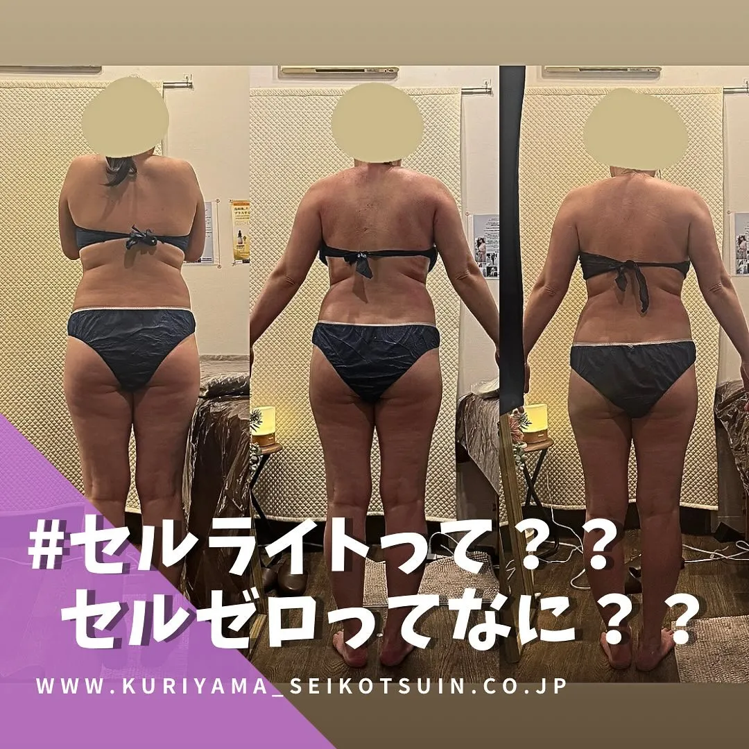 セルライトが気になる方におすすめ！西宮でダイエットならBodyリカバリー栗山整骨院にお任せください✨