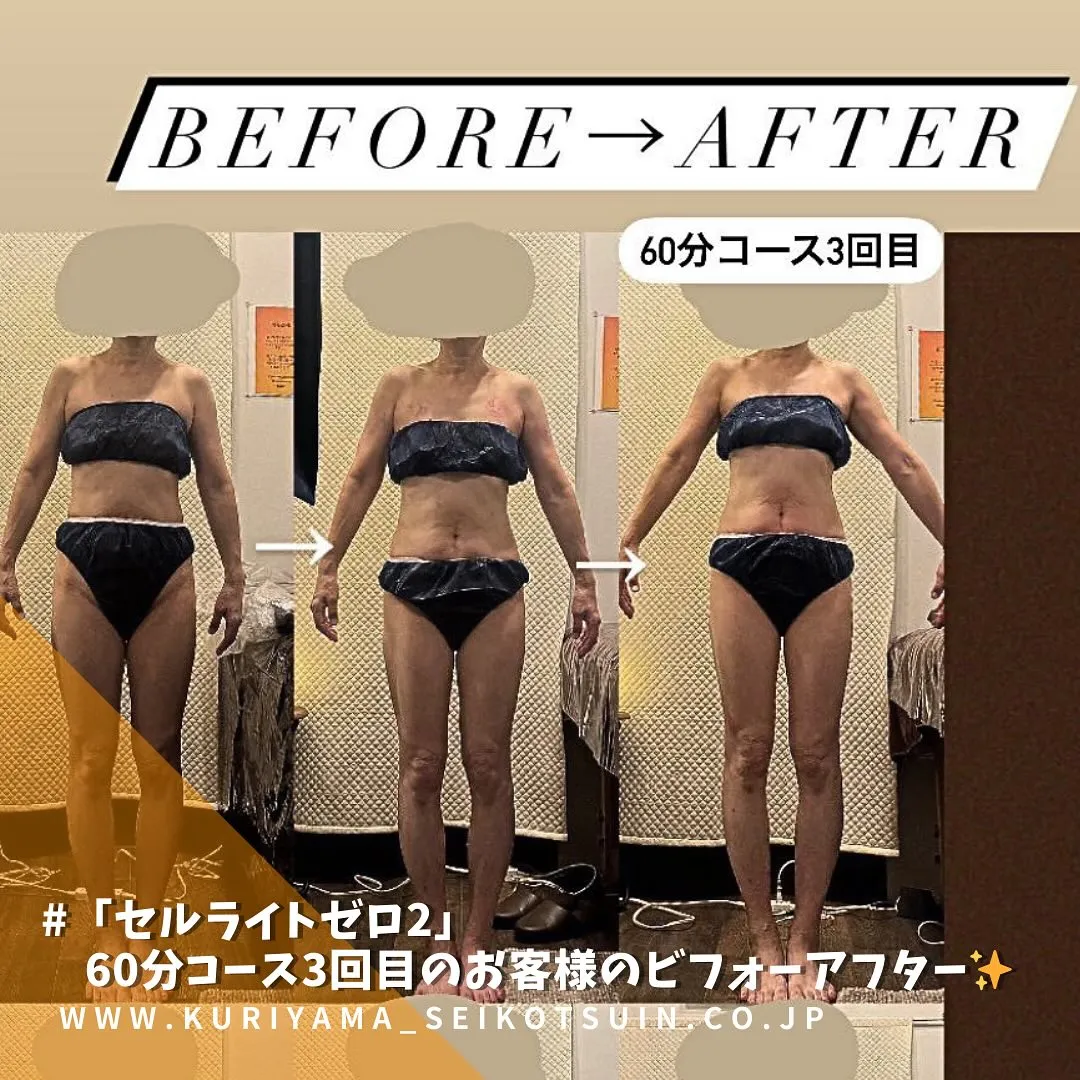 「セルライトゼロ2」で痩身ダイエット60分コースを3回受けたお客様のビフォーアフターの写真✨