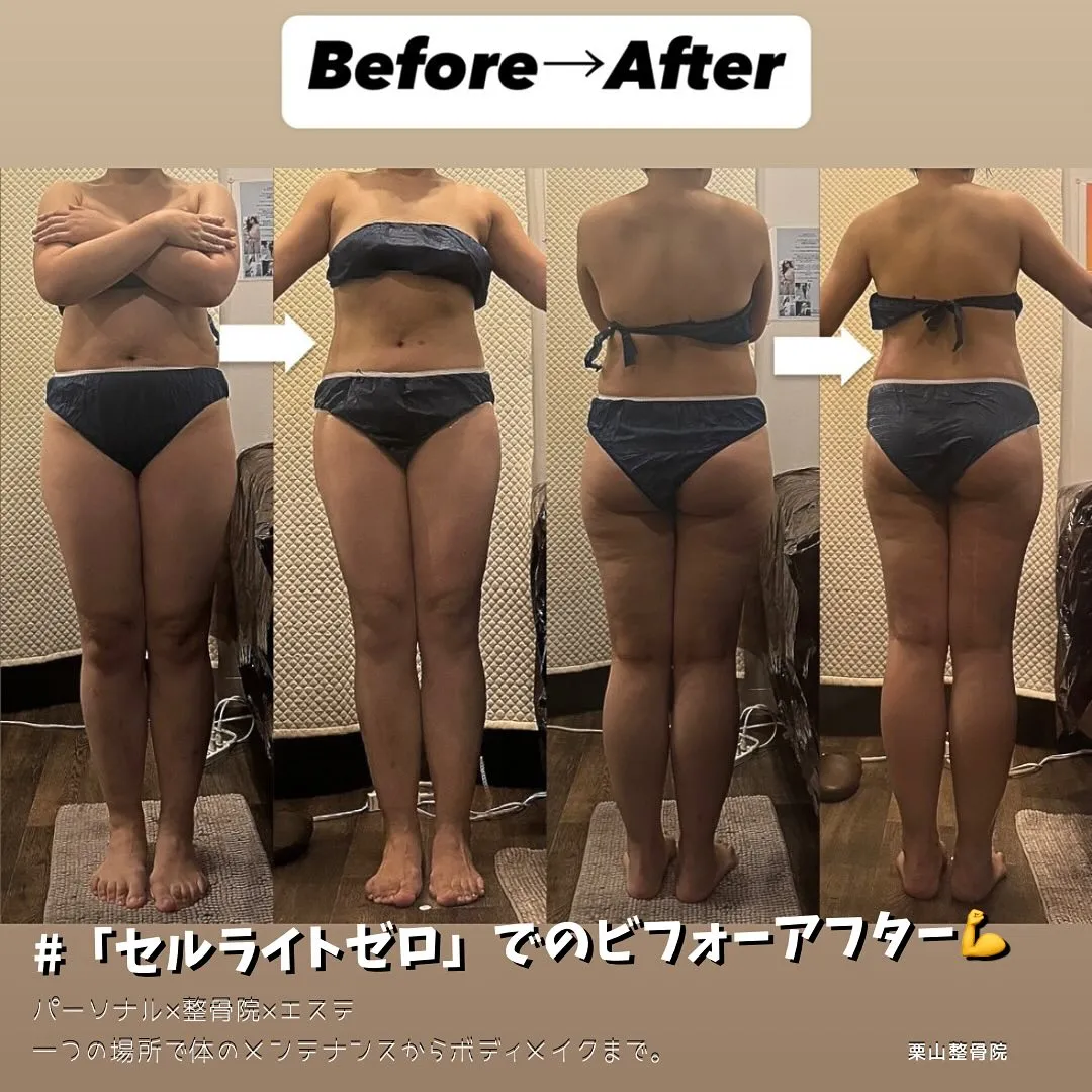 「セルライトゼロで痩身ダイエット」150分コースを週1で施術したお客様のビフォーアフター✨過度な食事制限など無し👌