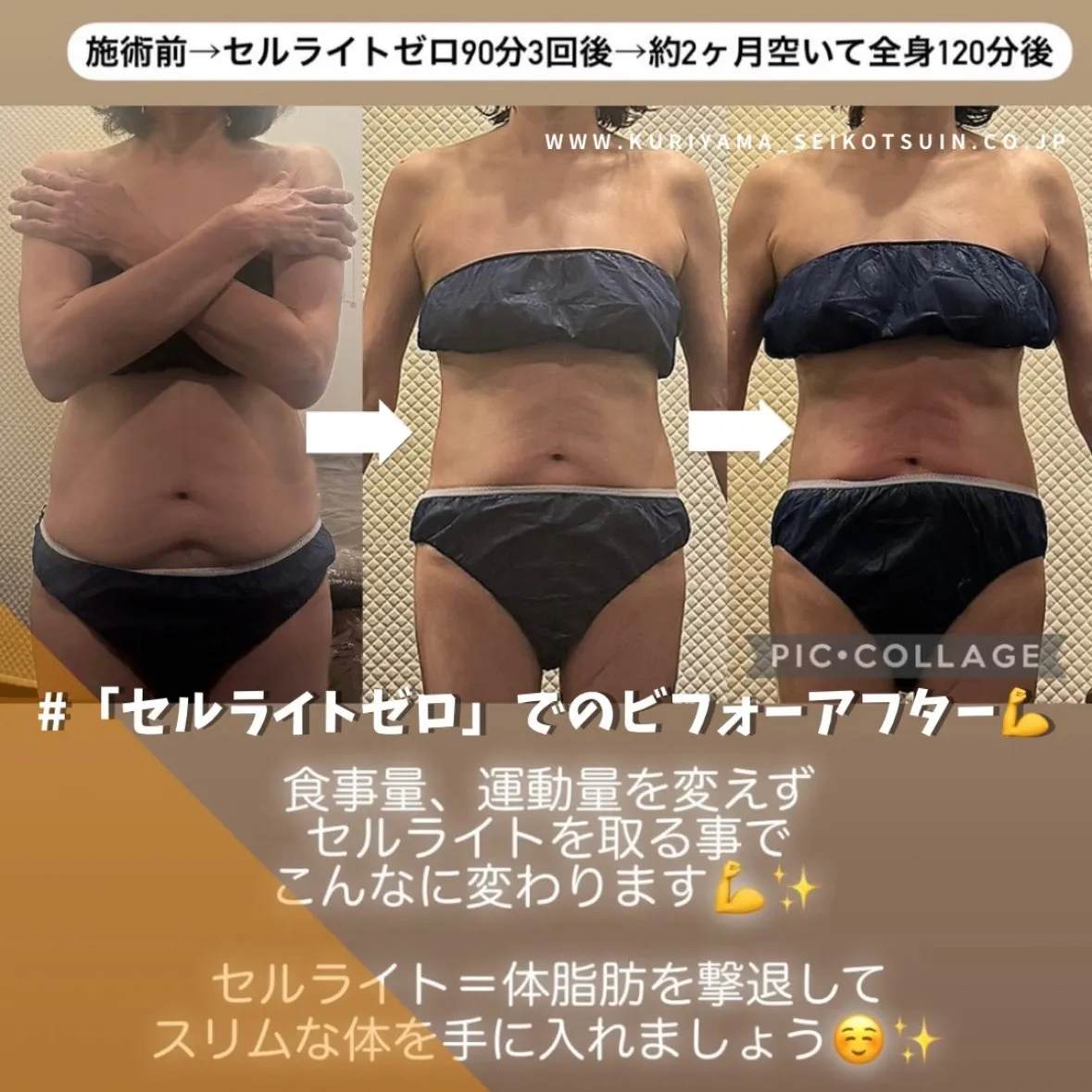 セルライトを撃退するマシンの施術をされたお客様のビフォーアフター✨切らない脂肪吸引で根本から改善する痩身ダイエット💪