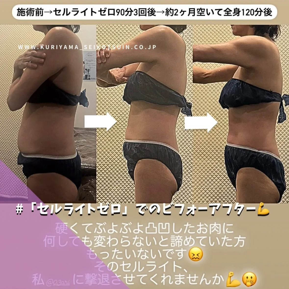 セルライトを撃退するマシンをされたお客様のビフォーアフター✨切らない脂肪吸引で根本から改善する痩身ダイエット💪