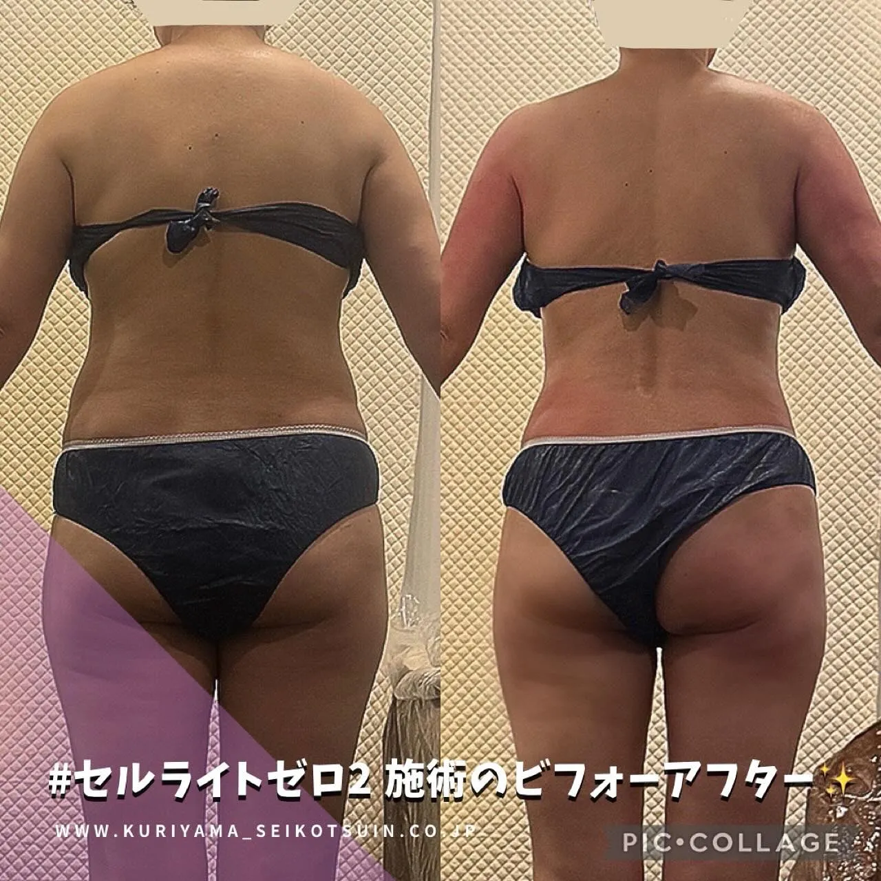 セルライトを撃退するマシンで施術したお客様のビフォーアフター✨切らない脂肪吸引で根本から改善するダイエット💪