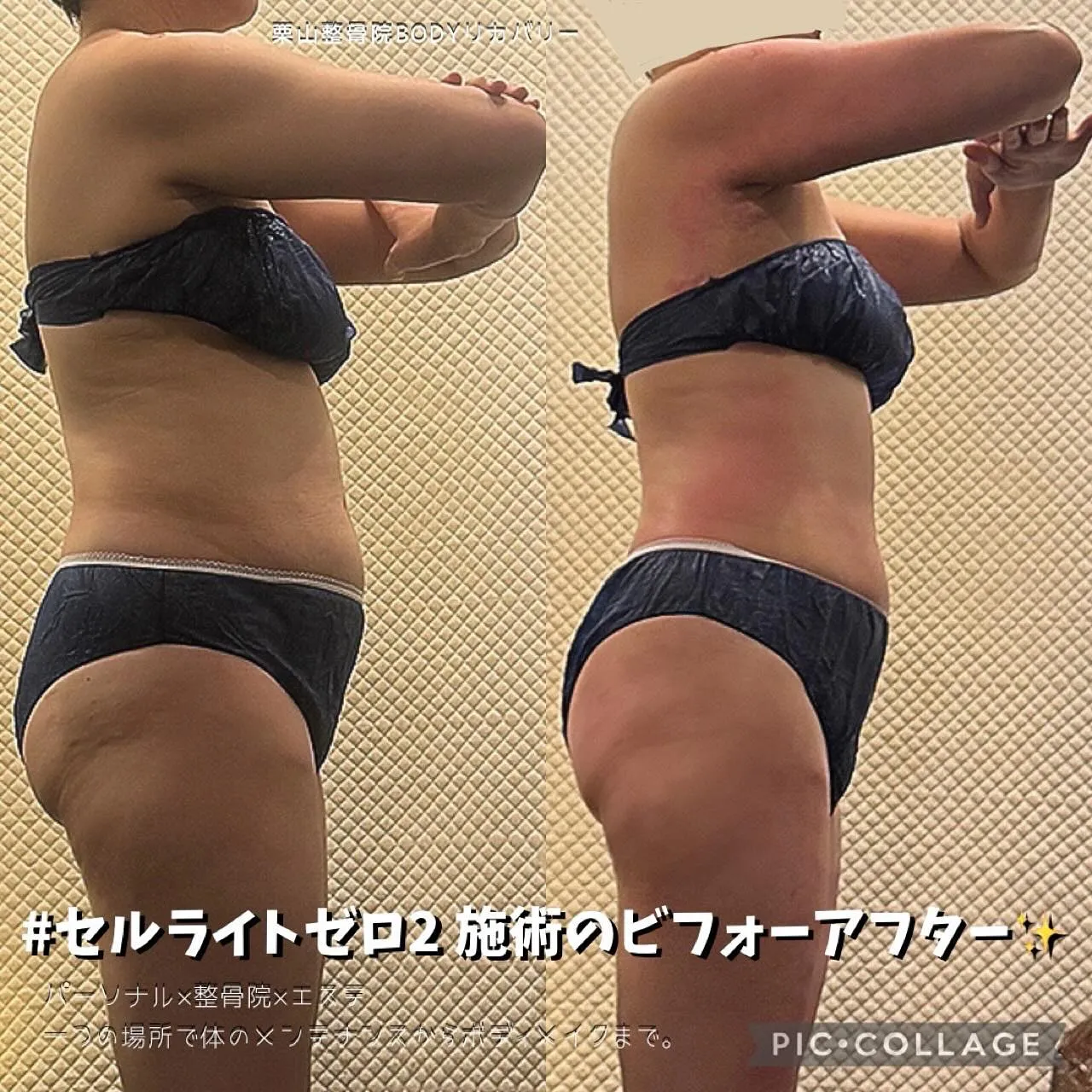普段の運動や食事は変えずにセルライトゼロ2の施術を受けて頂いたお客様のビフォーアフター✨切らない脂肪吸引で根本から改善💪