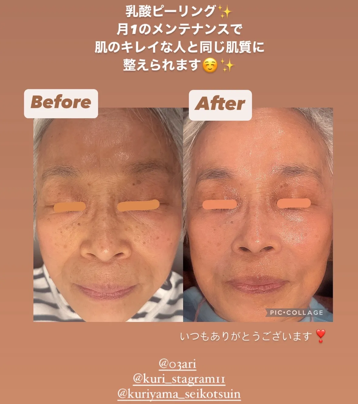 【西宮】乳酸ピーリング✨【エステ】