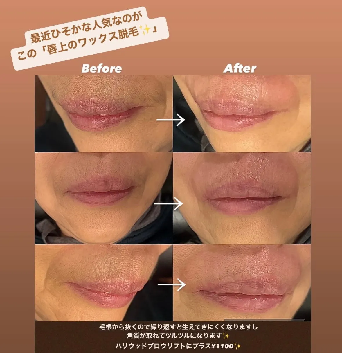 唇の上のワックス脱毛のビフォーアフター