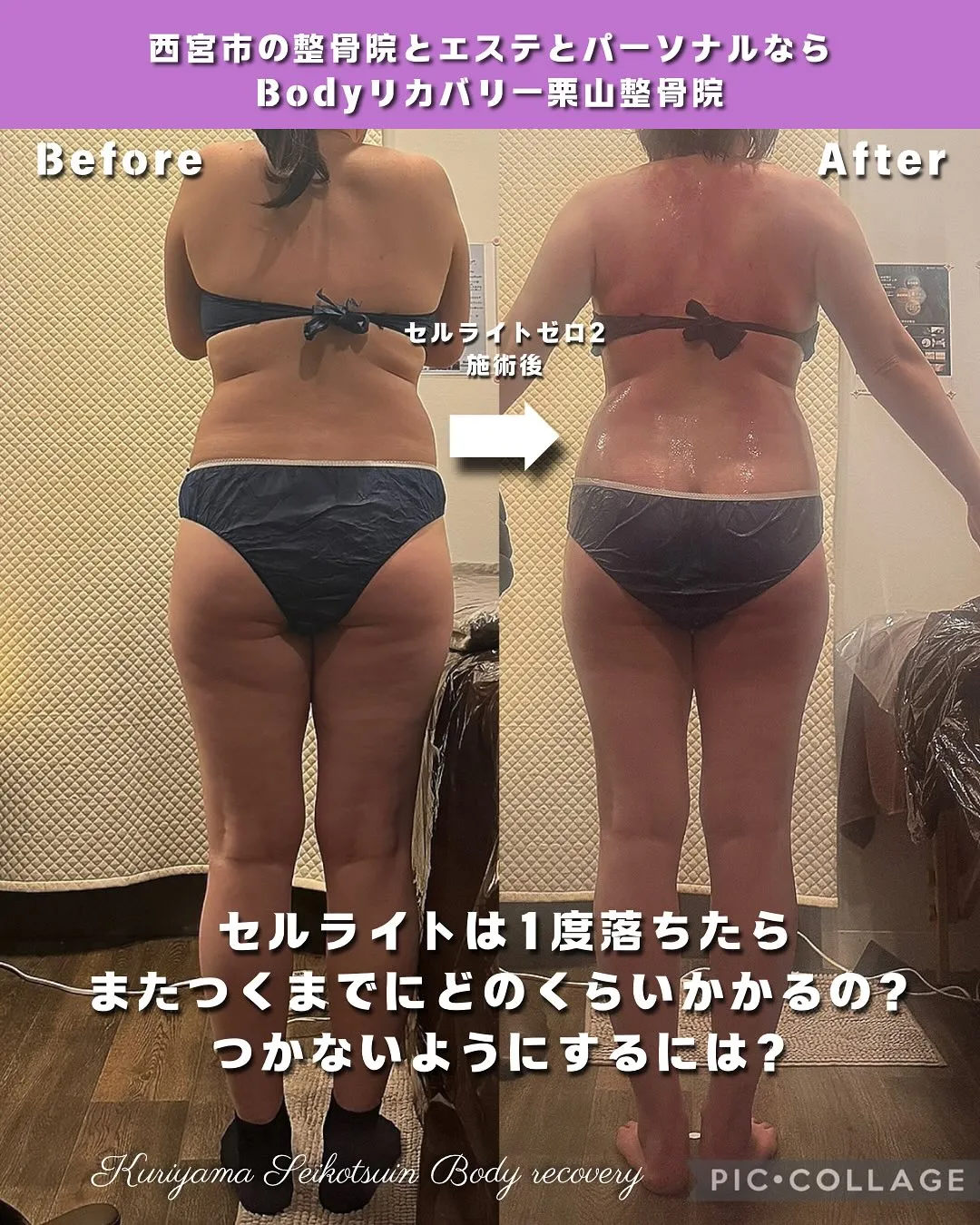 セルライトは1度落ちたらまたつくまでにどのくらいかかるの？つかないようにするには？