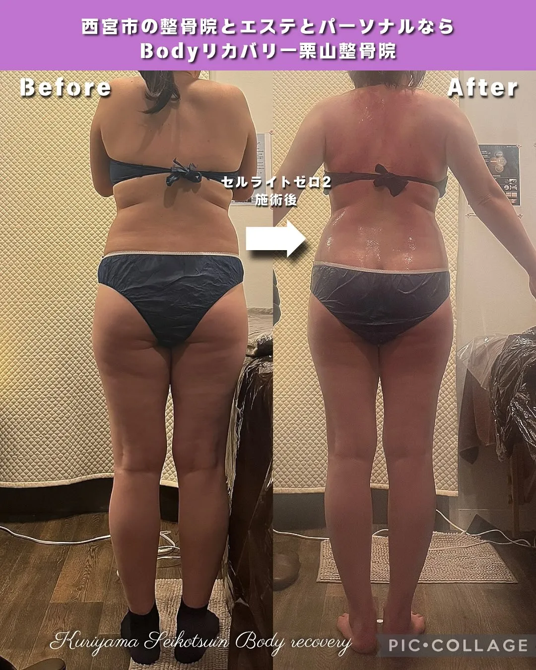 セルライトは1度落ちたらまたつくまでにどのくらいかかるの？つ...