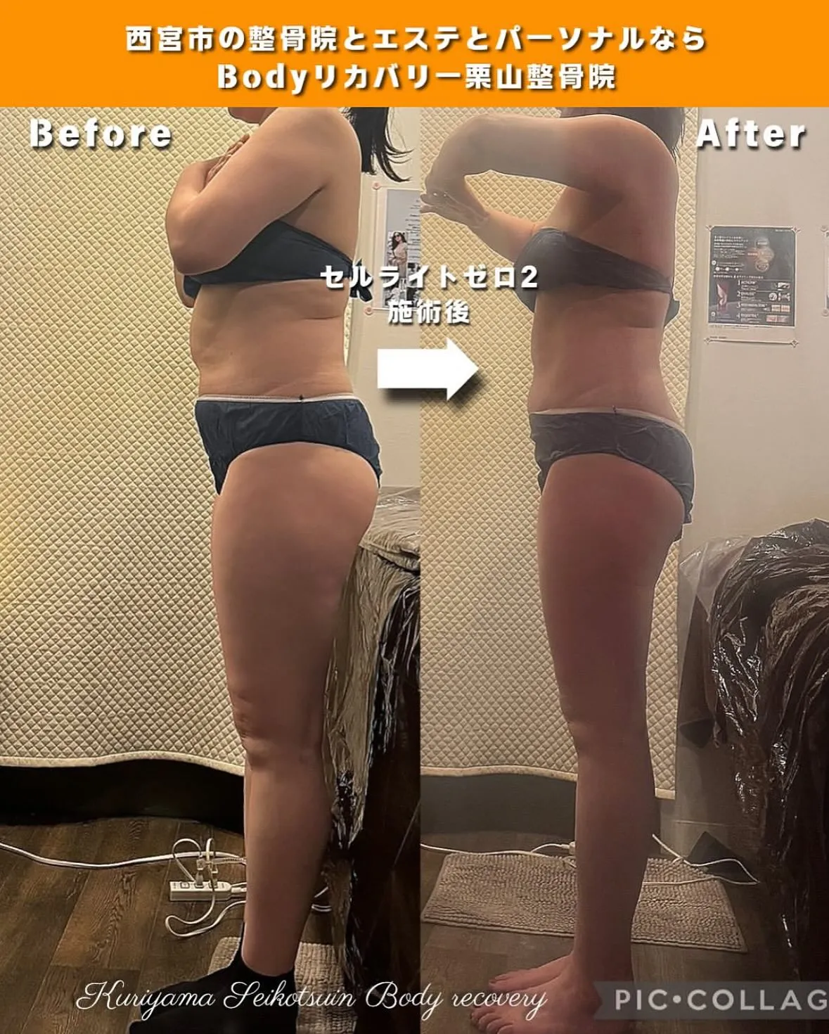 セルライトは1度落ちたらまたつくまでにどのくらいかかるの？つ...