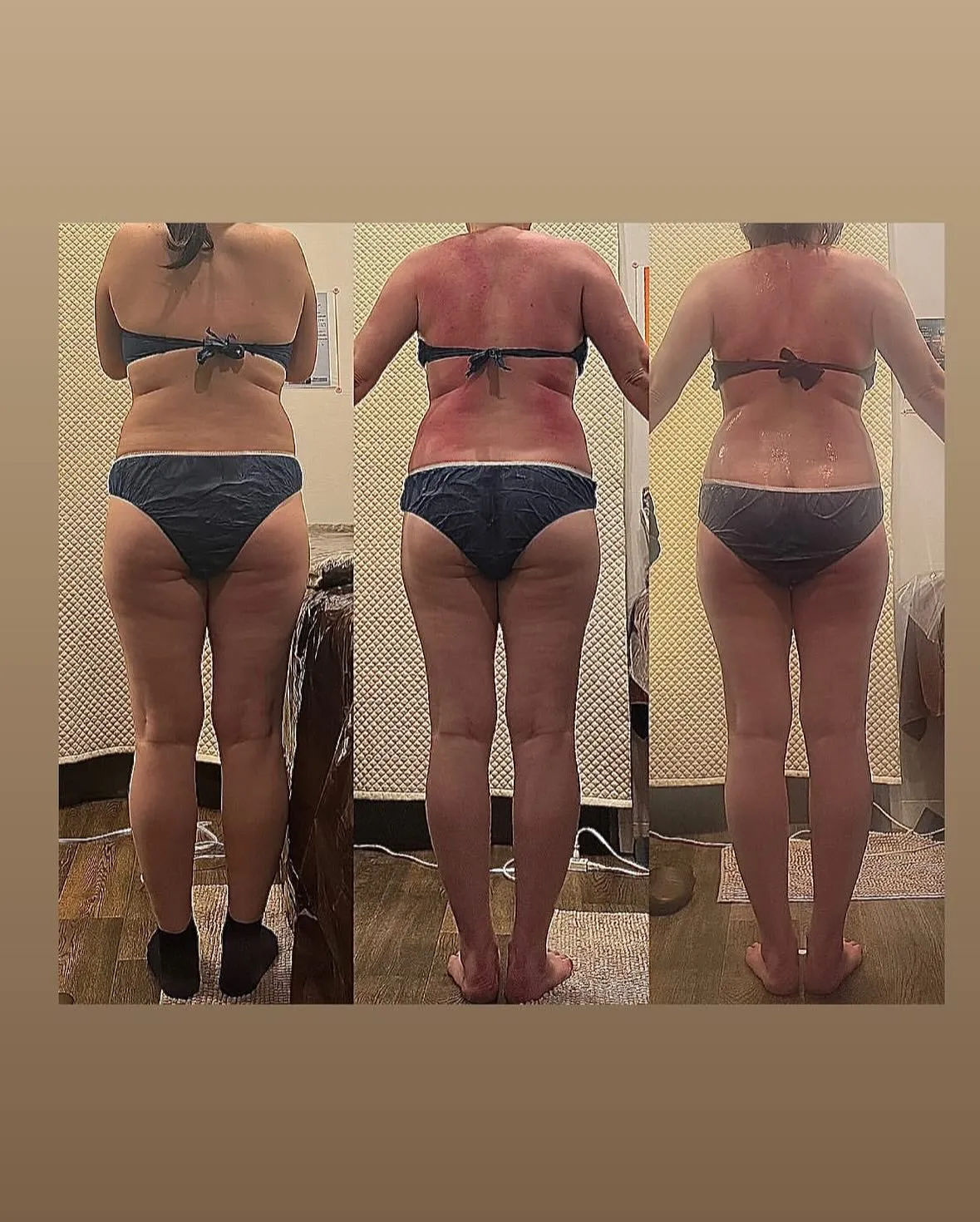 セルライトは1度落ちたらまたつくまでにどのくらいかかるの？つ...